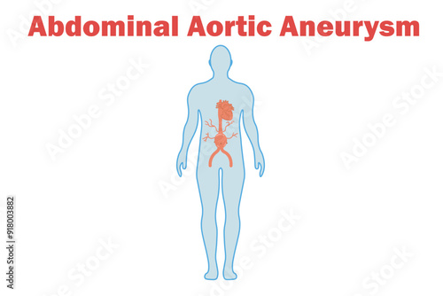 An abdominal aortic aneurysm is a bulging, weakened area in the lower part of the aorta. Similar vascular conditions include thoracic aortic aneurysm, aortic dissection,body,peripheral artery aneurysm