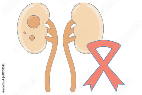 Kidney cancer starts in the kidneys. Similar diseases include renal cell carcinoma, Wilms tumor, and transitional cell carcinoma. It affects kidney function and may spread,red