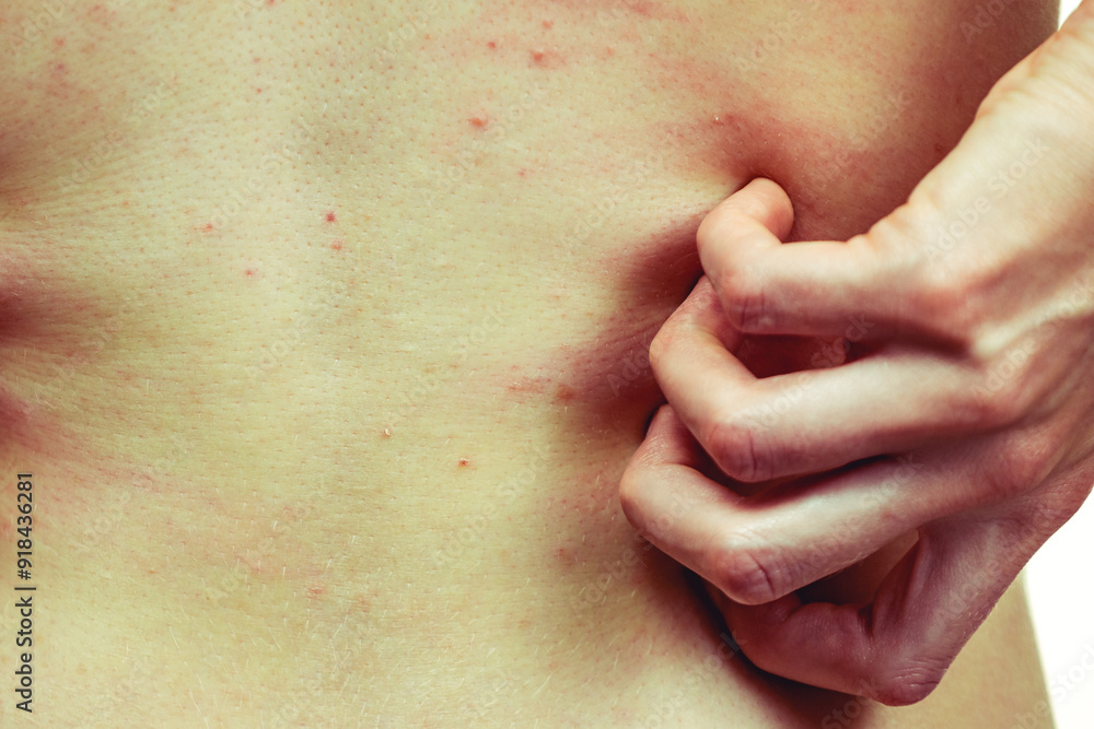 Woman scratching her itchy back with allergy rash Woman scratching her itchy back with allergy rash