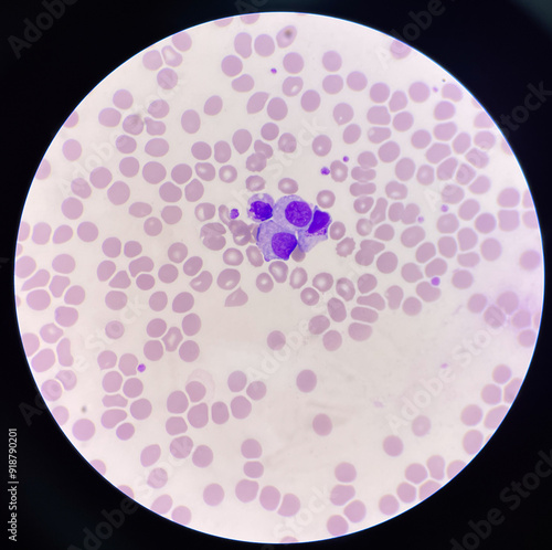 Abnormal blood cell