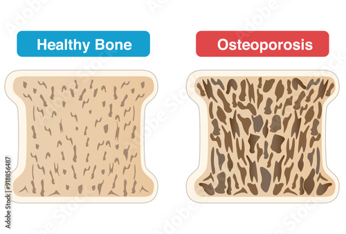 Comparison of cross-sectional views of osteoporotic and normal bone