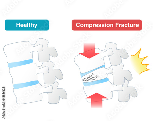 Mechanism of spinal compression fracture due to osteoporosis seen from the side