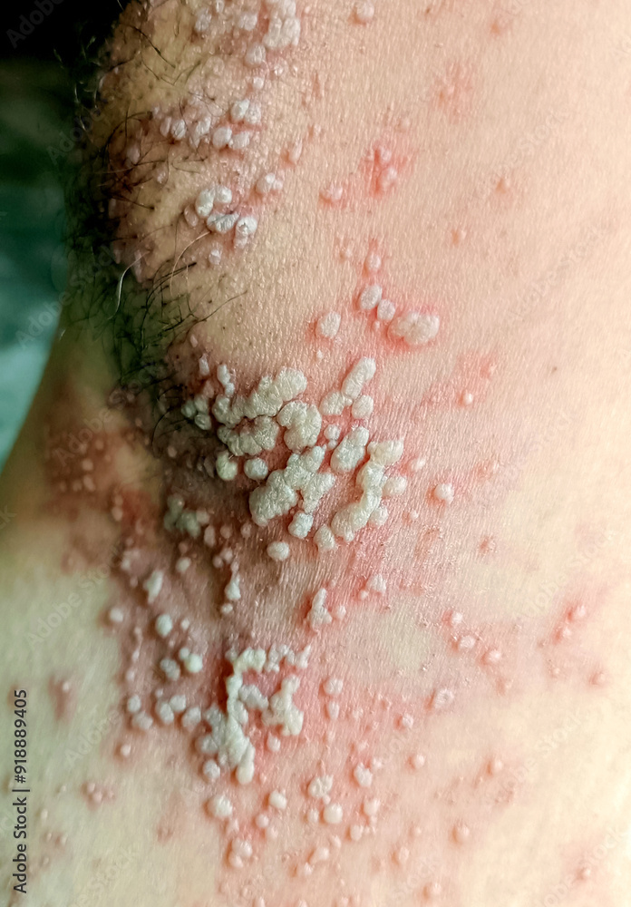 Fototapeta premium A Close up view of women with shingles (herpes zoster) disease on skin and he feel very painful