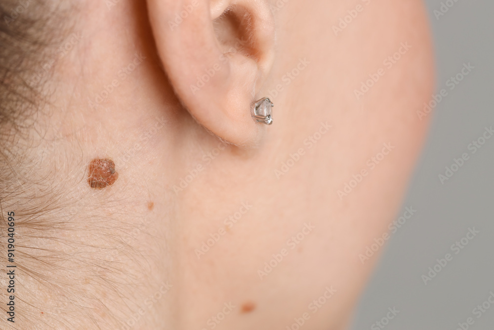 Woman with mole on her skin against grey background, closeup Woman with mole on her skin against grey background, closeup