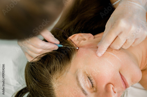 Cosmetic procedure with hyaluronic acid and tensor threads