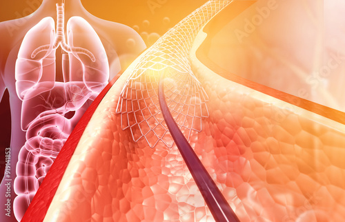 Fényképezés Stent implantation concept. 3d illustration