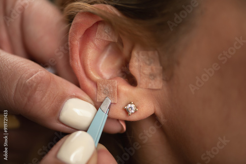 Canvastavla Acupuncturist stimulating auricular acupuncture points for treating anxiety