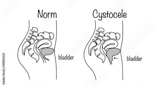 Cystocele