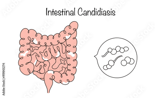 Intestinal Candidiasis