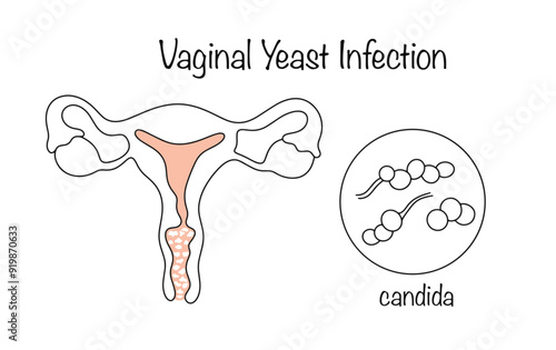 Vaginal Yeast Infection