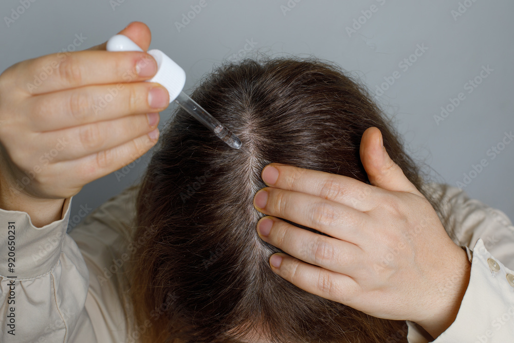 Fototapeta premium Women suffering from hair loss using hair serum or minoxidil to treat alopecia and hair loss