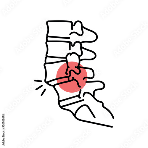 Spondylolisthesis color line icon. Diseases of the spine