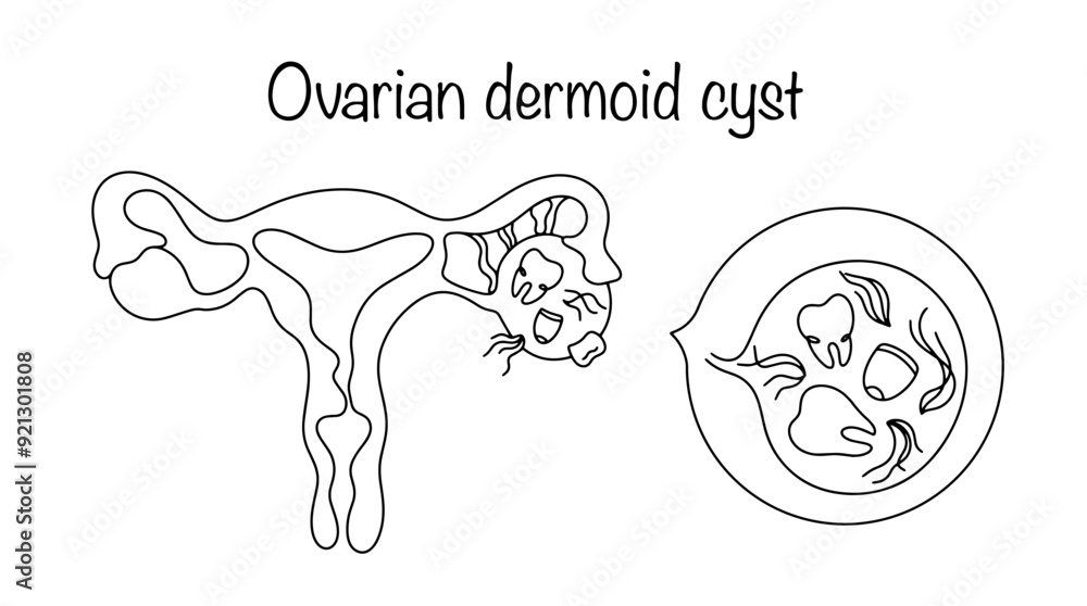 Obraz premium Ovarian dermoid cyst