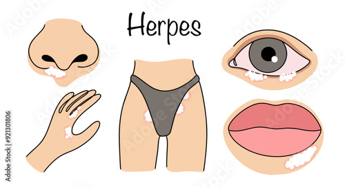 Herpes