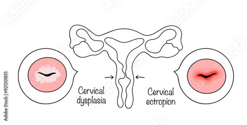 Pathologies of the cervix