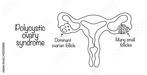 Polycystic ovary syndrome