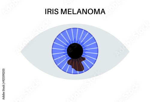 Iris melanoma anatomy