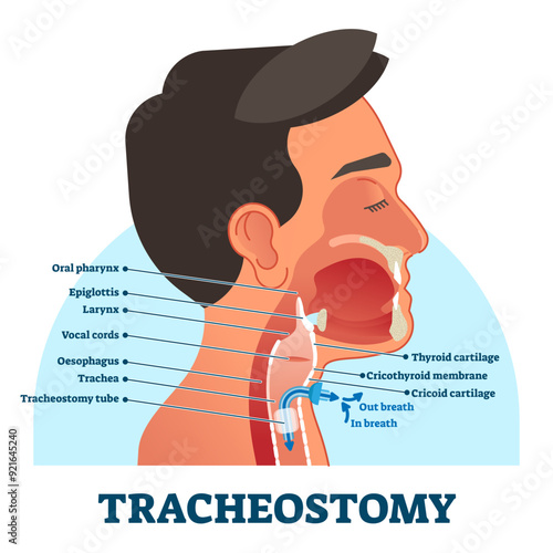 Tracheostomy cross section diagram, illustration labeled scheme, transparent background. Intensive care unit equipment medical technology. Throat parts and tube location for breathing.