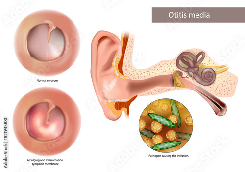 Obraz na płótnie Otitis Media or Chronic Suppurative