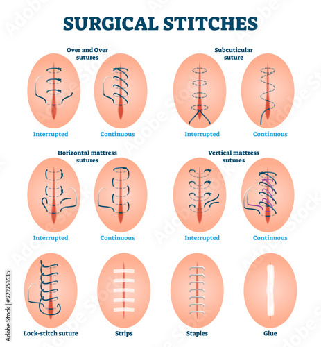 Surgical stitches illustration, transparent background. Labeled cut injury treatments. Skin wound care examples. Collection with interrupted and continuous over, subcuticular, mattress, strips.