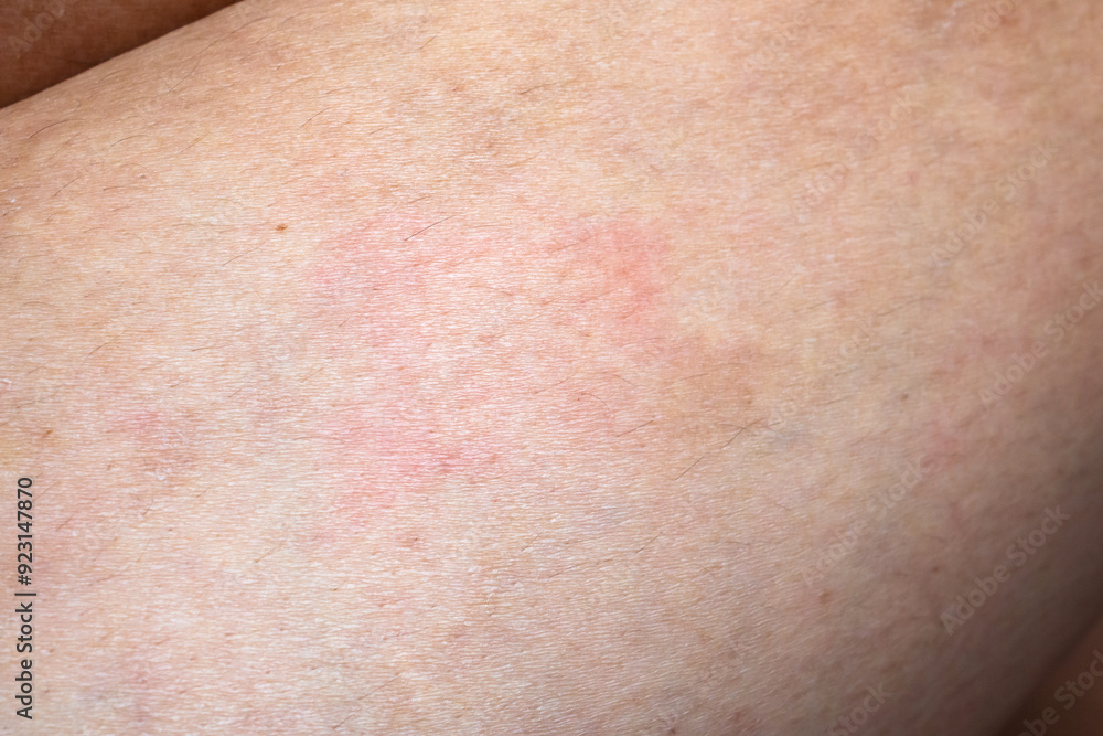 Fototapeta premium Skin allergy rash dermatitis texture close up