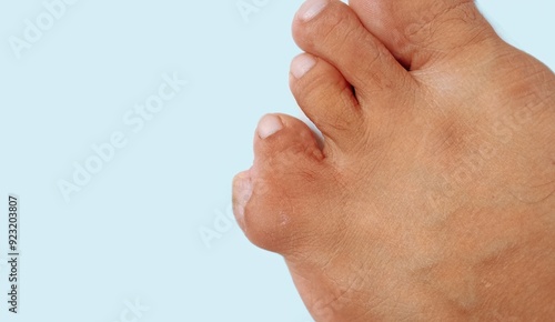 Photography Webbed Toes Medical Condition, Syndactyly Toes