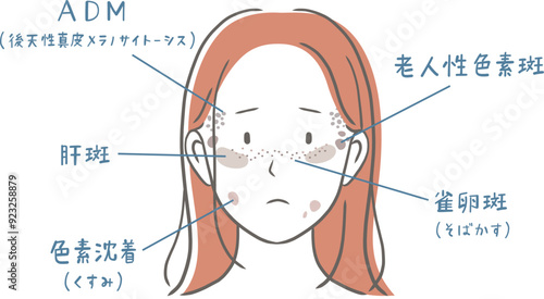シミの種類と女性の顔のイラスト素材