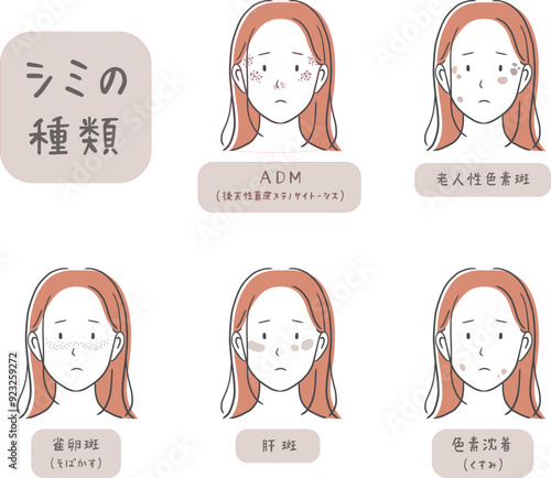 シミの種類と女性の顔のイラスト素材