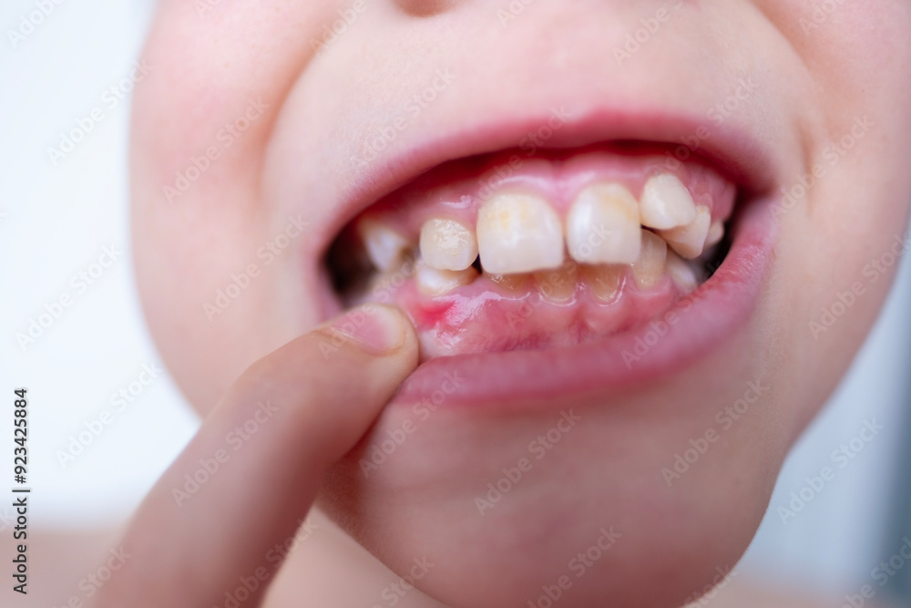 Fototapeta premium close-up teeth of child, boy 10 years old points new tooth fang in mouth with finger, concept children's health, pediatric dentistry, dental correction