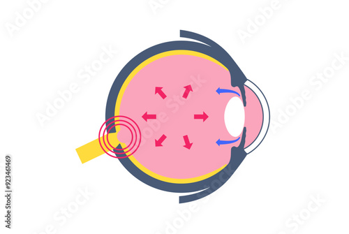 Glaucoma eye pressure