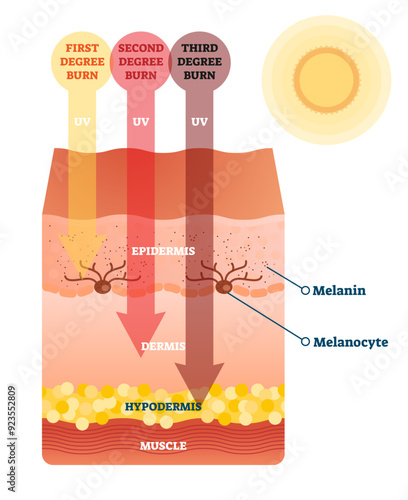 Sunburn skin damage anatomical cross section diagram, transparent background. Medical problem explanation scheme. UV light impact on epidermis, dermis and hypodermis layers.