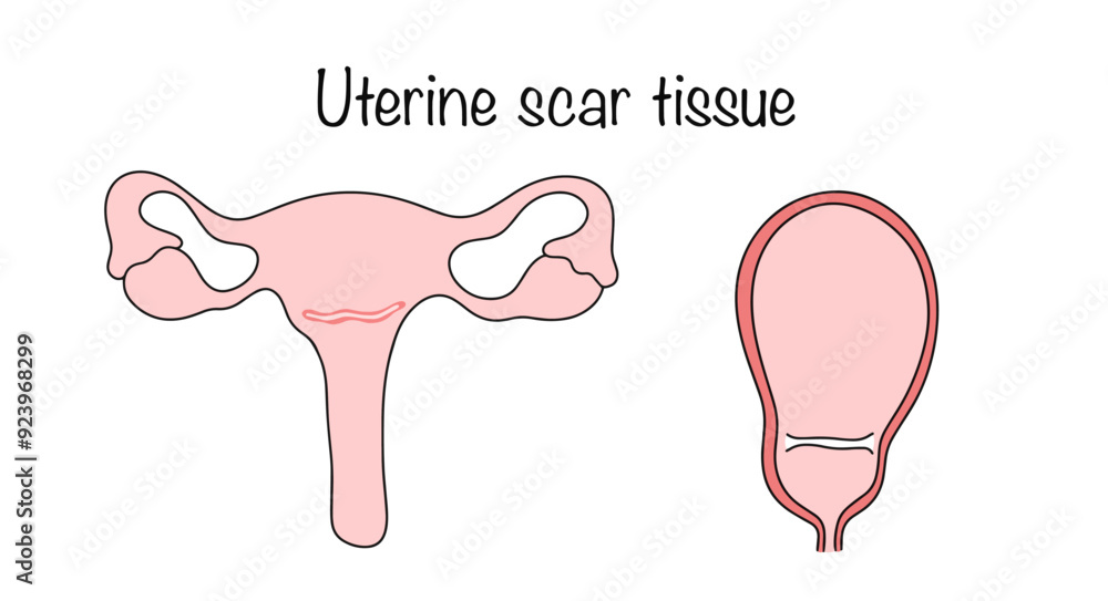 Uterine scar tissue Uterine scar tissue