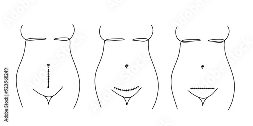 C-section procedure