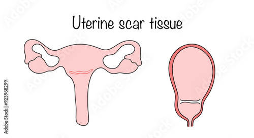 Uterine scar tissue