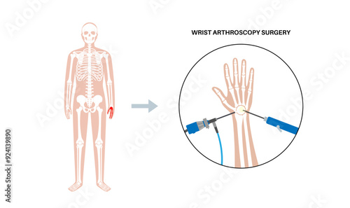 Wrist arthroscopy surgery