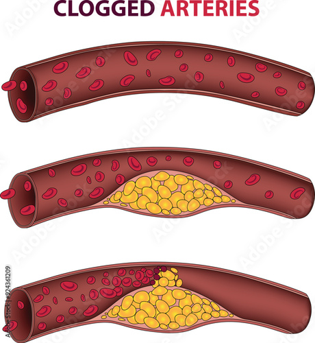 illustration of clogged arteries stages