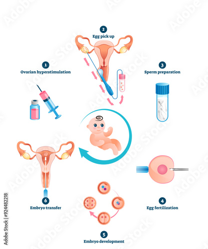 In Vitro fertilization artificial pregnancy reproduction illustration, transparent background.Labeled educational explanation with all procedure process steps and phases.