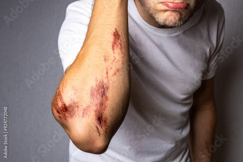 Obraz na plátne Man with a Large Abrasion Wound on his Arm