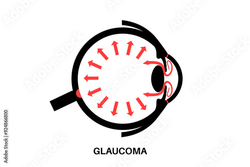 Glaucoma eye pressure