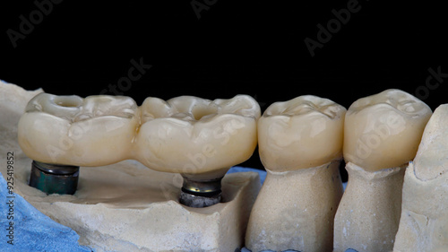 Dental crowns from zircon on a model from plaster