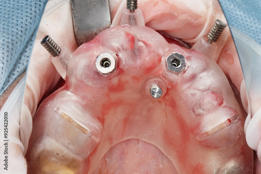 Fototapeta premium surgical dental template with two installed implants