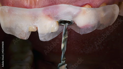 surgical dental cutter for bone preparation before implantation according to the template