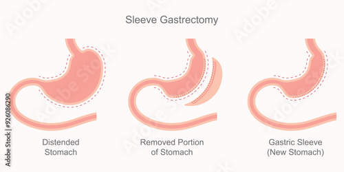 Sleeve gastrectomy, part of the stomach.