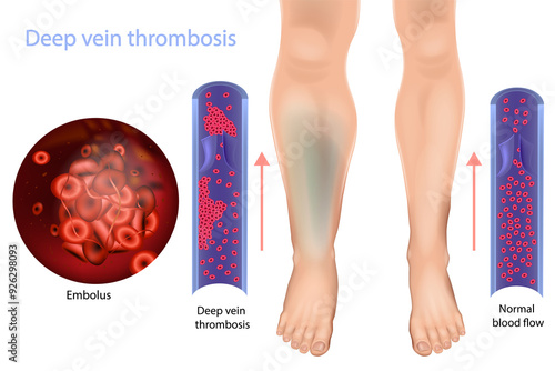 Foto Deep vein thrombosis and Normal blood flow