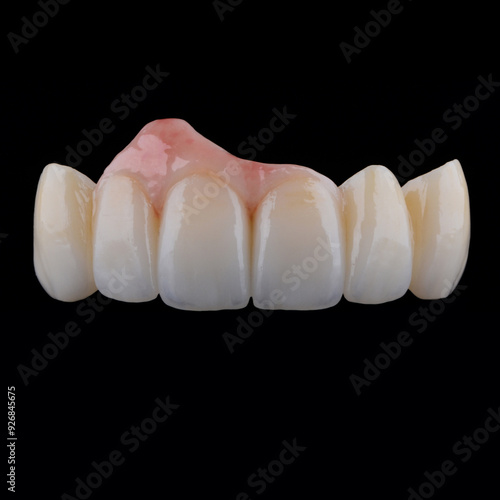 Naturally dental bridge with artificial gum made of zirconium for fixation to frontal upper teeth.