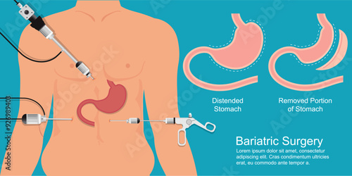 Bariatric surgery is done when diet and exercise.