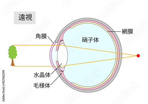 遠視のしくみをあらわした目の断面図1