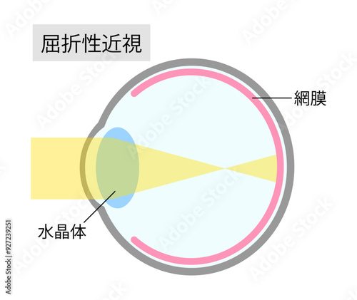 屈折性近視の眼球のシンプルなイラスト