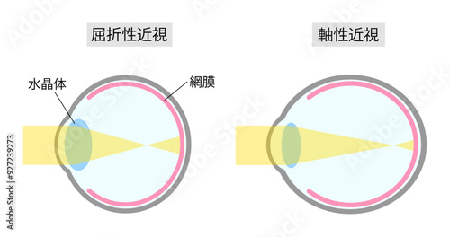屈折性近視と軸性近視のシンプルな比較イラスト