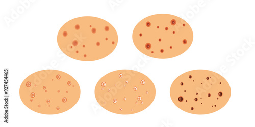 The Progressive Spread of Mpox: Stages of the Growing Disease.